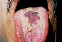 Hemorrhagie na sliznici jazyka