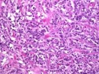 Fibróza lymfatické tkáně