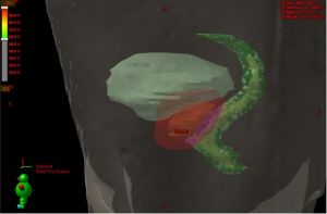 3D rekonstrukce anatomického vztahu PTV (prostata a bezpečnostní lem) a kritických orgánů (močový měchýř (modře) a rektum (zeleně)