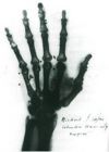 Snímek ruky Berthy Röntgenové, jeden z prvních rentgenových snímků, pořízený 28. 12.1895