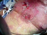 Postradiační poškození kůže I. - II. stupně