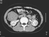 CT snímek břicha