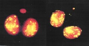 Mikrojádra, obsahující pouze fragment chromozomu (neoznačené, nalevo)  nebo cely chromozom (označené protilátkami specifickými pro centromery, napravo)