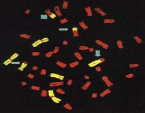 Translokace mezi chromozomy označena šipkami, detekce metodou FISH